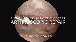 Arthroscopic rotator cuff repair of a full-thickness tear of the shoulder