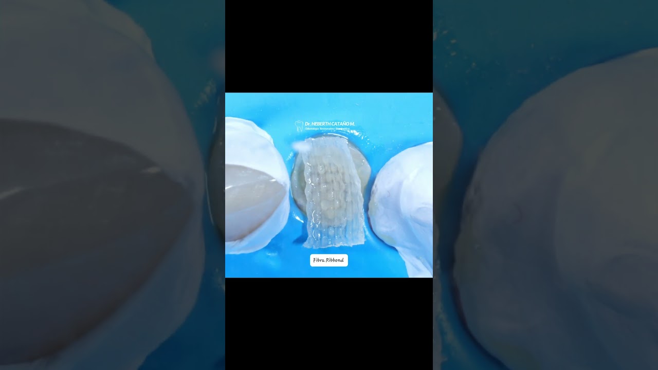 BioBase en Diente Tratado con Endodoncia