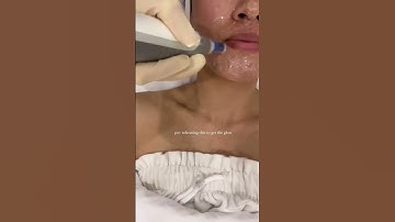 Microneedling powered by Dermapen 4™ is the ultimate way to achieve healthy skin