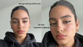 NO FOUNDATION 10 min summer makeup routine (with acne)