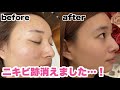 【花嫁美容】結婚式に向けて本気で美容!劇的ビフォーアフター大公開!