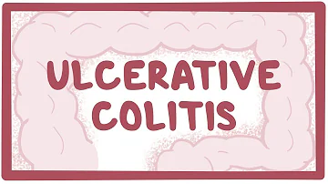 How does ulcerative colitis start?