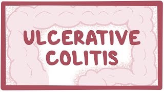Ulcerative colitis  causes, symptoms, diagnosis, treatment, pathology