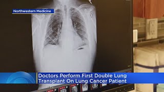 Doctors perform first double lung transplant on lung cancer patient