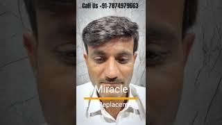  Change your looks in 50 minutes in SURAT ️‍ hair replacement system