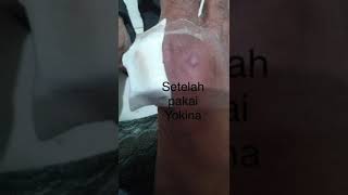 Diabetes And Stroke Diseases With Herbal Treatment