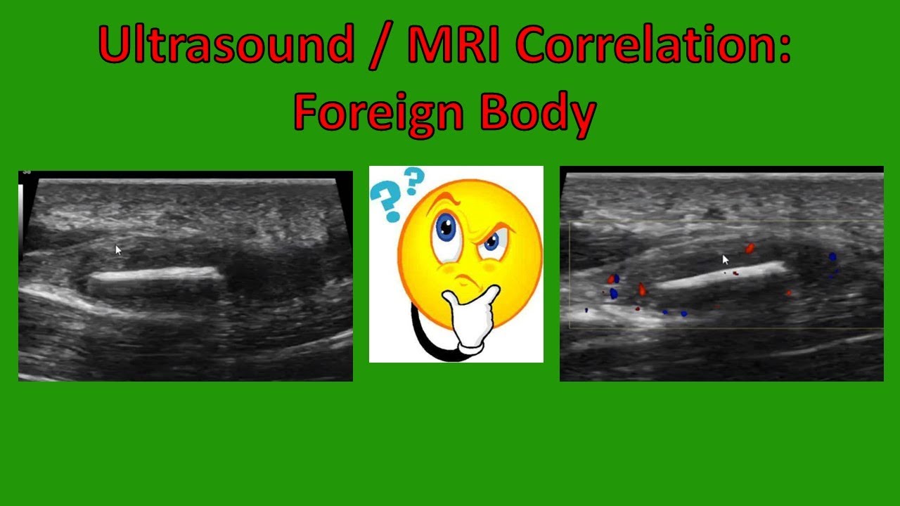 Ultrasound / MRI Mass Correlation Nonradiopaque Foreign Body (updated