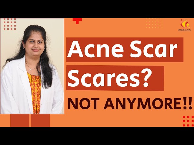 Acne Scar treatment| Must know facts about acne scars| Expert Talk from Venkat Center