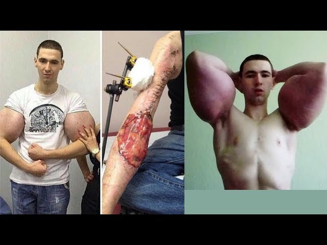 Video: 'The Synthol Kid' Gets 'Alien' Injections in Face, Refusing Doctor  Recommendations – Fitness Volt