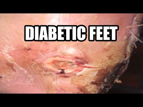 worst-diabetic-feet-on-planet-earth!