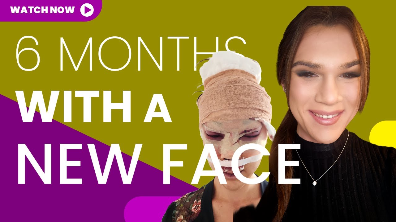 6 Months After FFS. Complications and Result | Regrets, Tips, Tricks, Reality | MTF Surgery Timeline