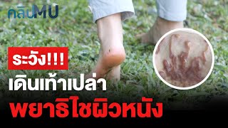 ระวัง!! เดินเท้าเปล่า พยาธิไชผิวหนัง | คลิป MU [Mahidol Channel]