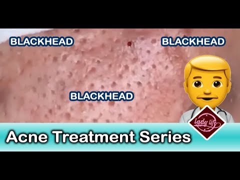 How to Get Rid of Blackheads,Cystic Acne, Whiteheads on Nose,Acne Treatment Part: