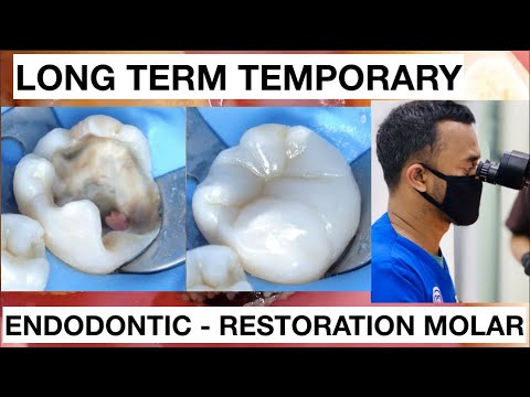 Dental Endodontic Direct Restoration Long Term Temporary Composite | General Dentist Griya RR