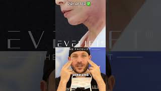 EVE Lift™ To Restore The Jawline | Eden Plastic Surgery: Dr. Ali Charafeddine, MD