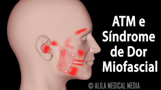 Disfunção na Articulação Temporomandibular: Thaiz Arrabal dá dicas para  diagnóstico