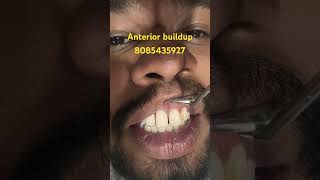 Anterior buildup#compositerestoration#compositematerials#compositenumber