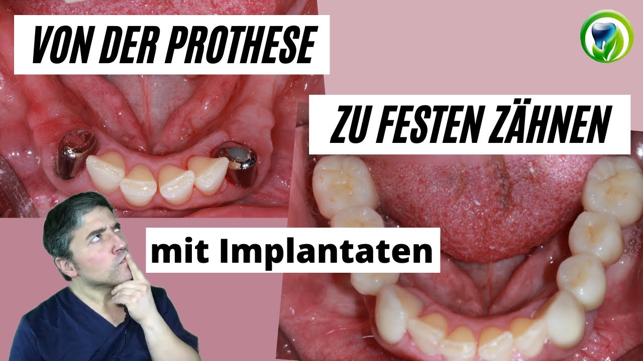 Teleskopprothese Sitzt Seit Einer Woche Fest Und Geht Nicht Raus Von defekter Teleskopprothese zu festen Zähnen mit Implantaten, Kronen