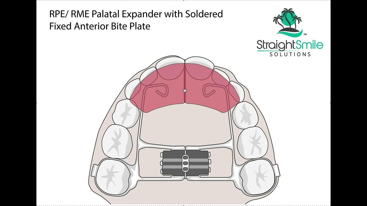 RPE RME FBP Expander with Fixed Anterior Bite Plate Deepbite and
