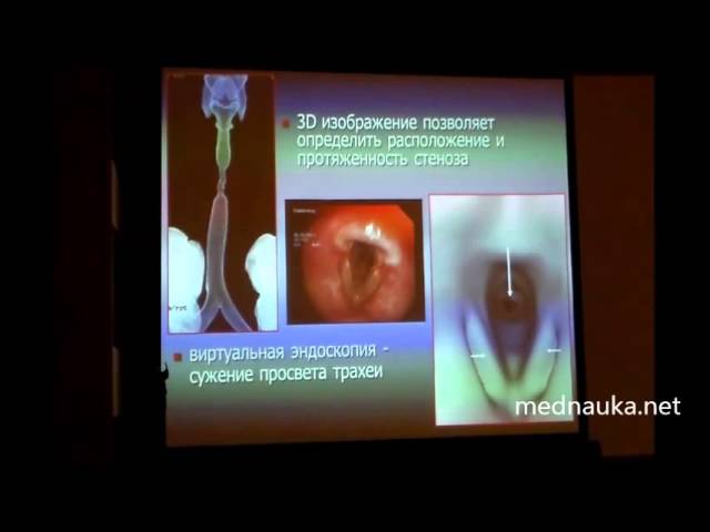 Компьютерная томография при патологии гортани и трахеи