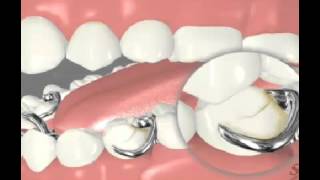 Partial Dentures Disadvantages