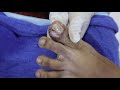 Ep_1424 Ingrown toenail removal 👣 เหมือนมีดปักไว้ 😷 (This clip is from Thailand)