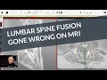 Lumbar Fusion Surgery Gone Wrong: A Live MRI Review