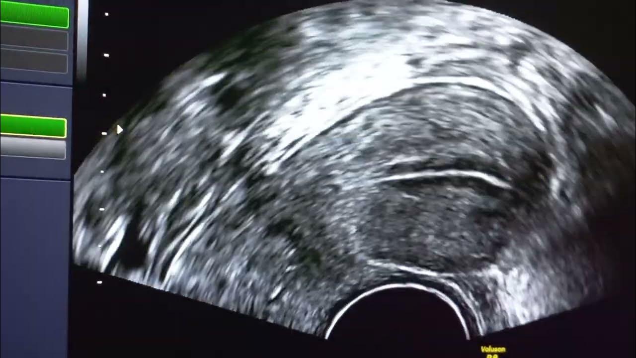 iui success in first attempt. eggs, and uterus ultrasound. iui with rfsh hmg dual trigger YouTube