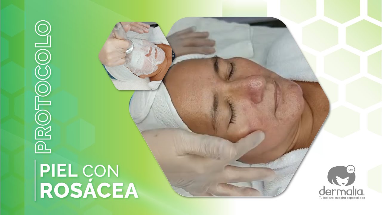 PROTOCOLO PARA PIEL ROSÁCEA
