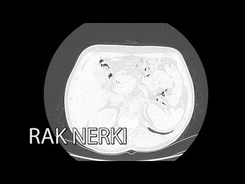 Wideo: Rak Nerki (gruczolakorak) U Psów