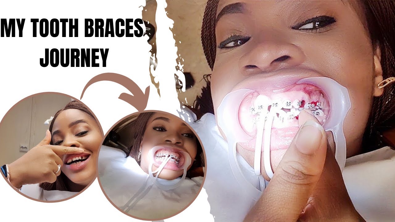 My Tooth Braces Journey\\ WHAT to Expect The DO`S and DONT`S + How to