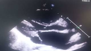 Shone Complex Supramitral Ring , Subaortic Membrane