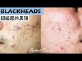 超級黑的粉刺(SUPER BLACK blackheads) - Taiwan Tainan台南清粉刺最乾淨