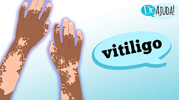 Qual o remédio caseiro que é bom para vitiligo?