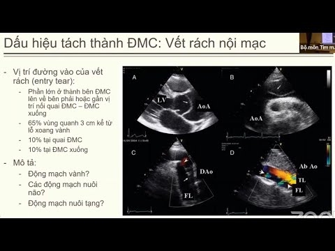 Video #11 Siêu âm trong Phình tách Động mạch chủ, BS Đỗ Thúy... - YouTube