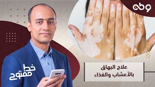 تعرف على طرق علاج طبيعية لمرض البهاق.. مع خالد مشرف