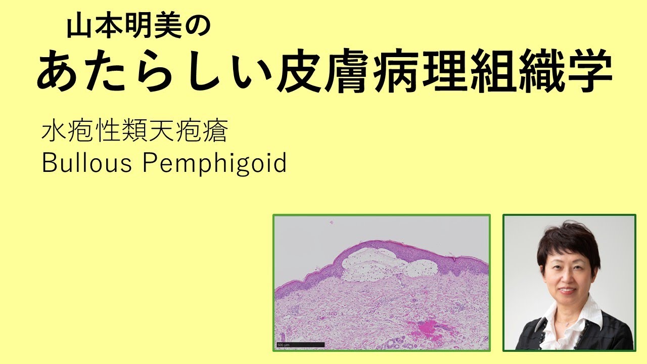 種痘様水疱症とは – 種痘様水疱症 Hv症例 – 第 42 回日本小児感染症学会教育講演 – DOGEEW