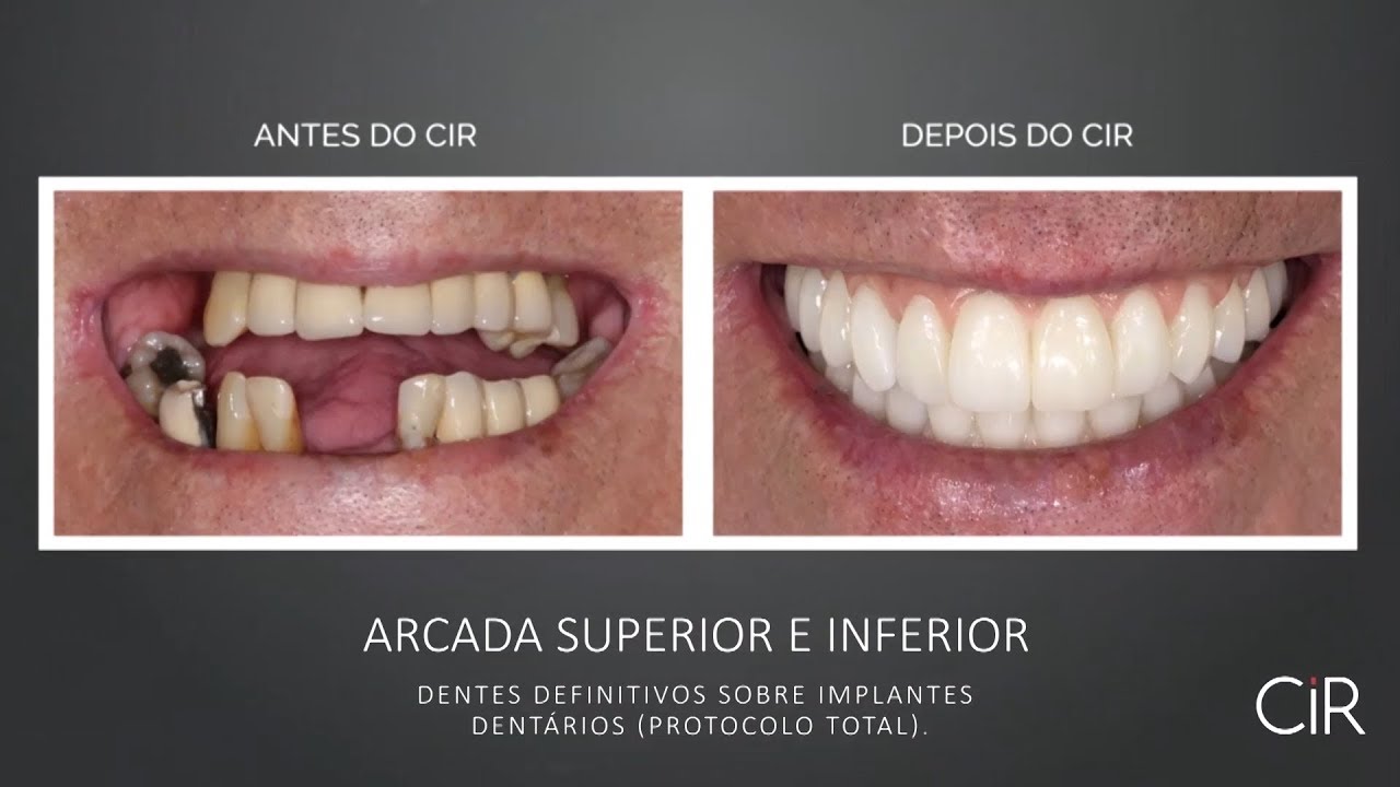 Quanto Tempo Depois Do Implante Pode Colocar O Dente Provisório Antes e Depois - Implantes Dentários (Protocolo Total) - YouTube