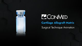 Cartilage Allograft Matrix - Conmed Animation