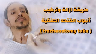 طريقة تركيب انبوب الفتحه العنقية | how to change the tracheostomy tube