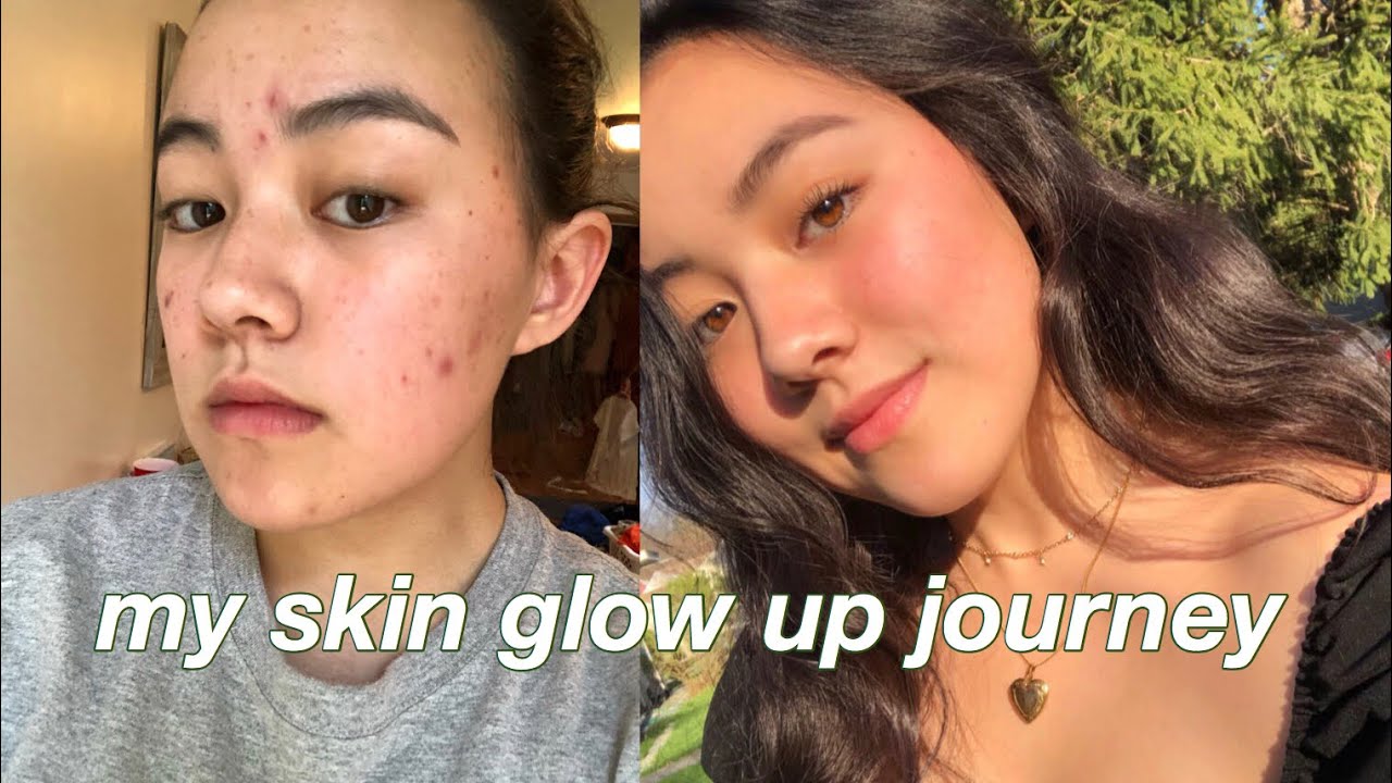 How I got rid of my ACNE (*my skincare routine*) - YouTube