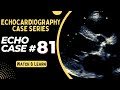 Echo case 81  echocardiography spot diagnosis series  echocardiogram interpretation made easy