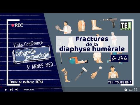 05 | Fractures de la diaphyse humérale