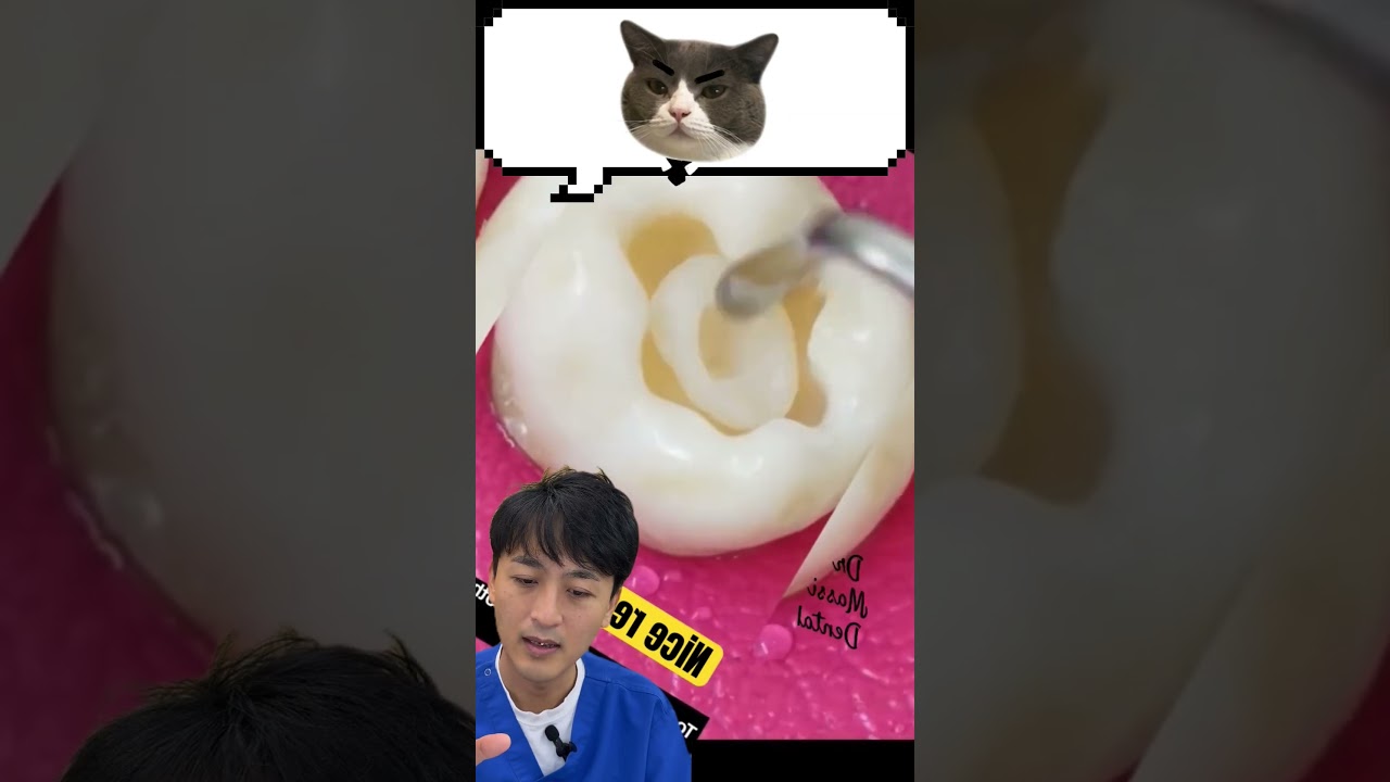 🦷歯の溝の治療🦷 #金歯先生 #歯医者 #dentist #歯科医師 #shorts #歯科矯正 #マウスピース矯正 #口臭 #ホワイトニング #歯石 #虫歯