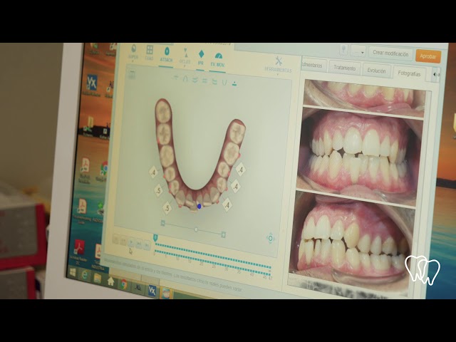 Clínica Meyden - Estudio Invisalign con paciente real realizado por la Dra. Sra Risoto
