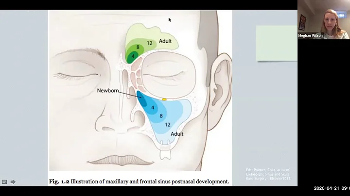 Pediatric Skull Base Surgery - Dr. Meghan Wilson