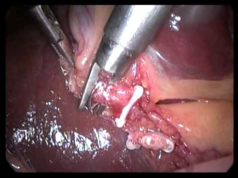 Lap. Cholecystectomy (unedited-195)-Simple Chronic Cholecystitis Large GB