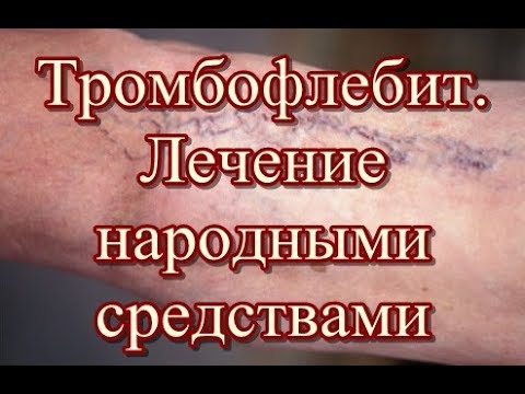 Тромбофлебит. Лечение народными средствами