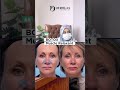 Laugh lines Treatment for 40+ | Dr Bushra Abdullah