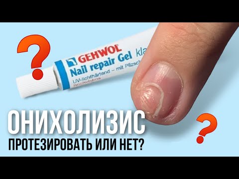 Ногти против гололеда, часть 2/ можно ли закрыть онихолизис материалом?/ протезирование ногтя